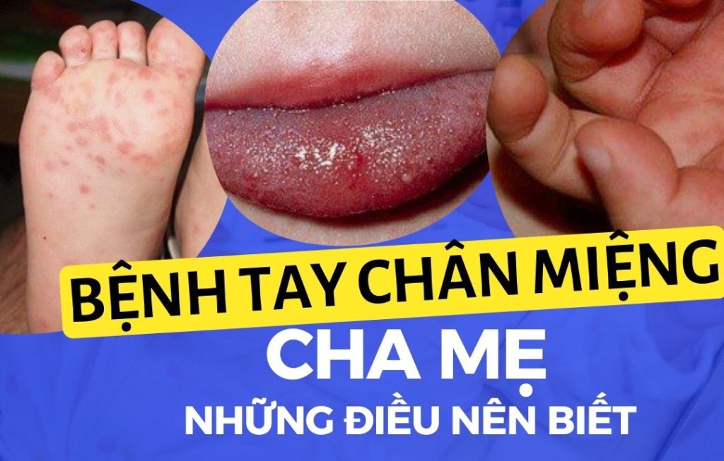 20 Bệnh tay chân miệng - Những điều cha mẹ cần biết Go1care