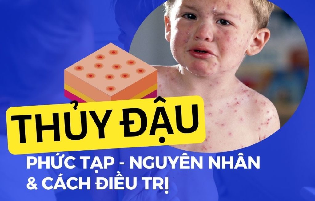 23 Thủy đậu phức tạp - Nguyên nhân và cách điều trị Go1care