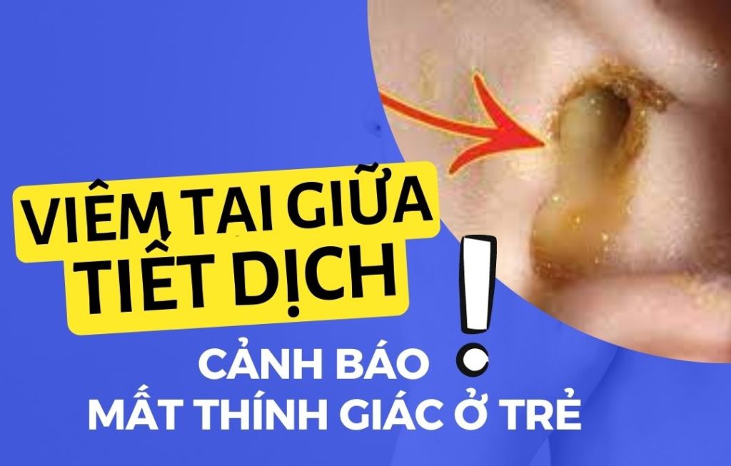 7 Viêm tai giữa tiết dịch Go1care