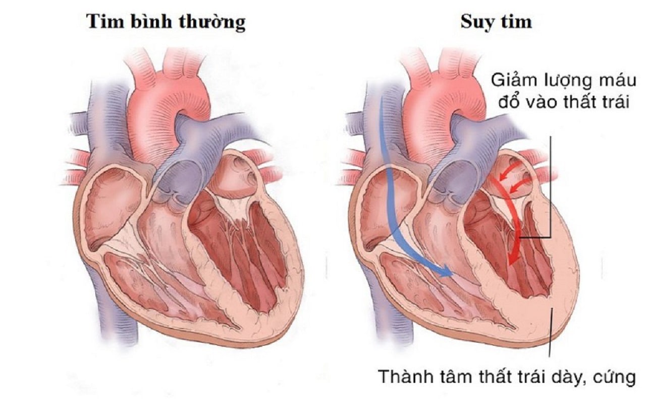 Triệu chứng tăng huyết áp và cách điều trị