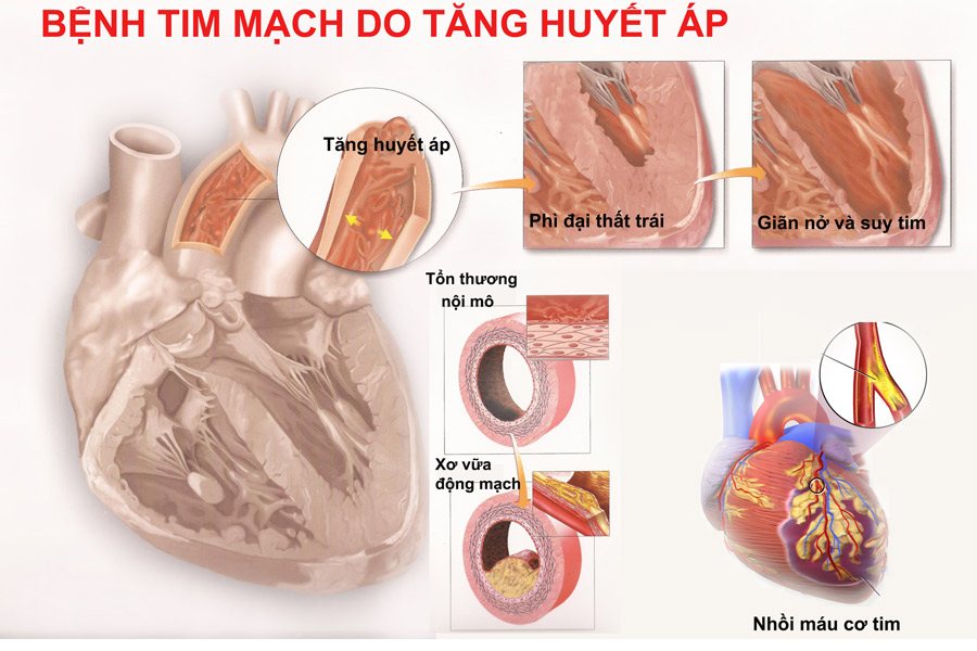 bien chung tim mach Các Biến Chứng Nguy Hiểm Do Cao Huyết Áp Gây Ra Go1care