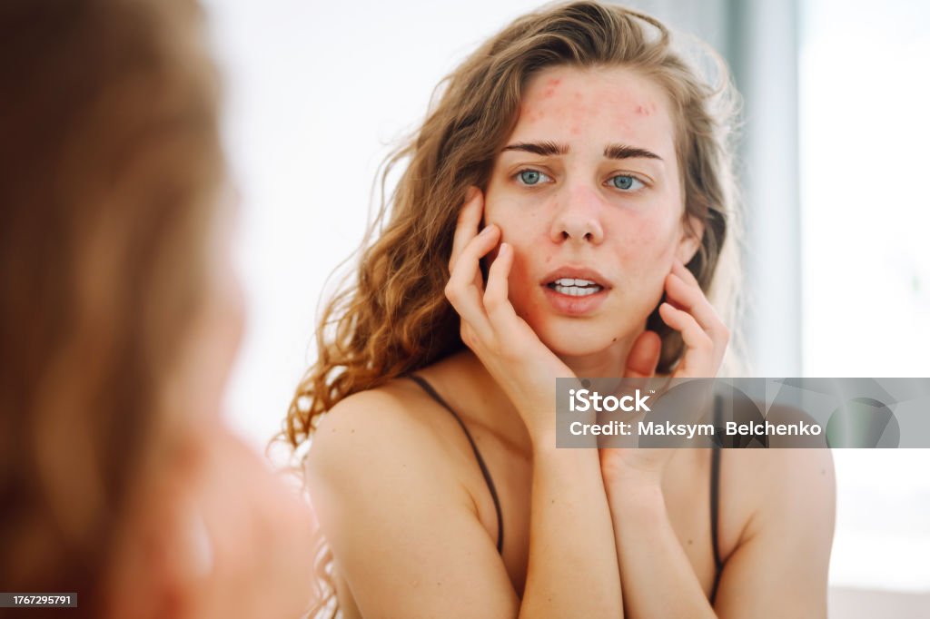 istockphoto 1767295791 1024x1024 1 Dị Ứng Với Kem Chống Nắng, Phải Làm Sao? Go1care