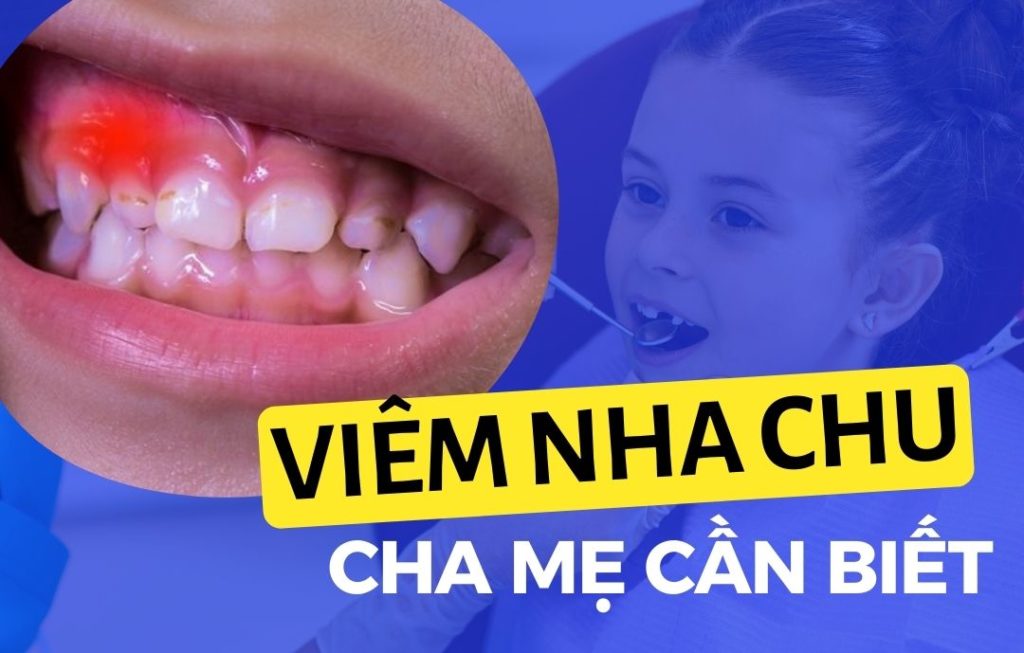 12 Viêm nha chu ở trẻ - Dấu hiệu và điều trị Go1care