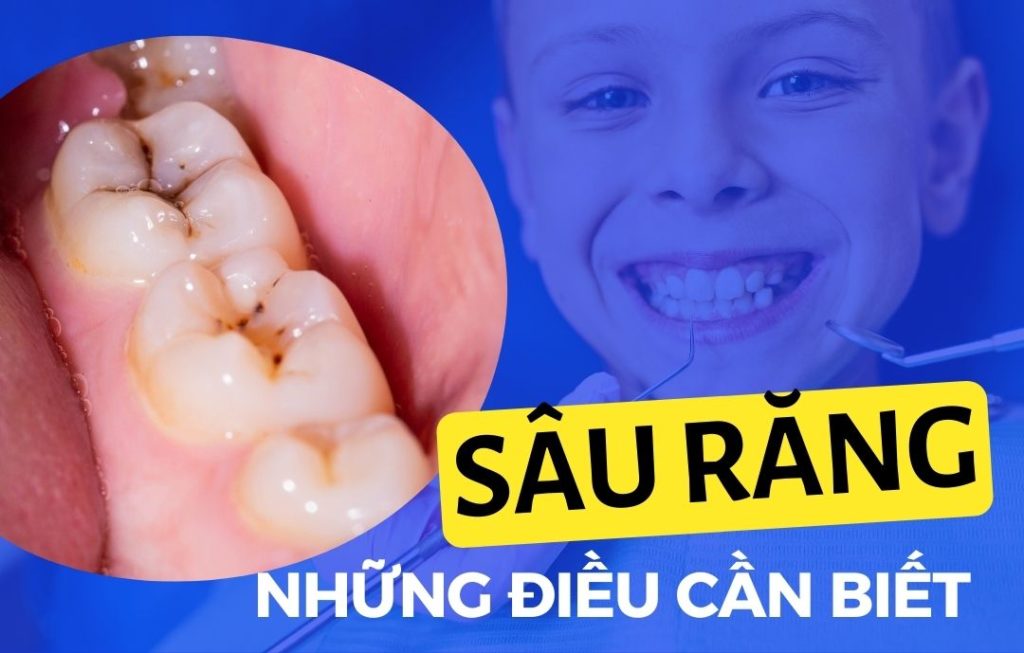 13 Sâu răng những điều cần biết để điều trị Go1care