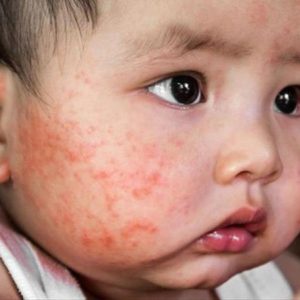 Benh cham la gi Bác sĩ Hoàng Minh Tài Go1care