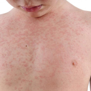 Bác sĩ CKI Đinh Thị Huyền Trang Phat ban o tre em Bác sĩ CKI Đinh Thị Huyền Trang Go1care