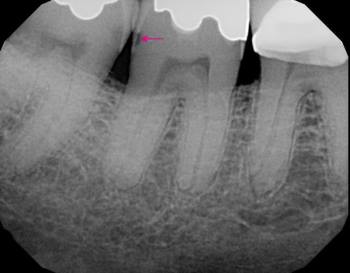 decay xray high 2 Sâu răng những điều cần biết để điều trị Go1care
