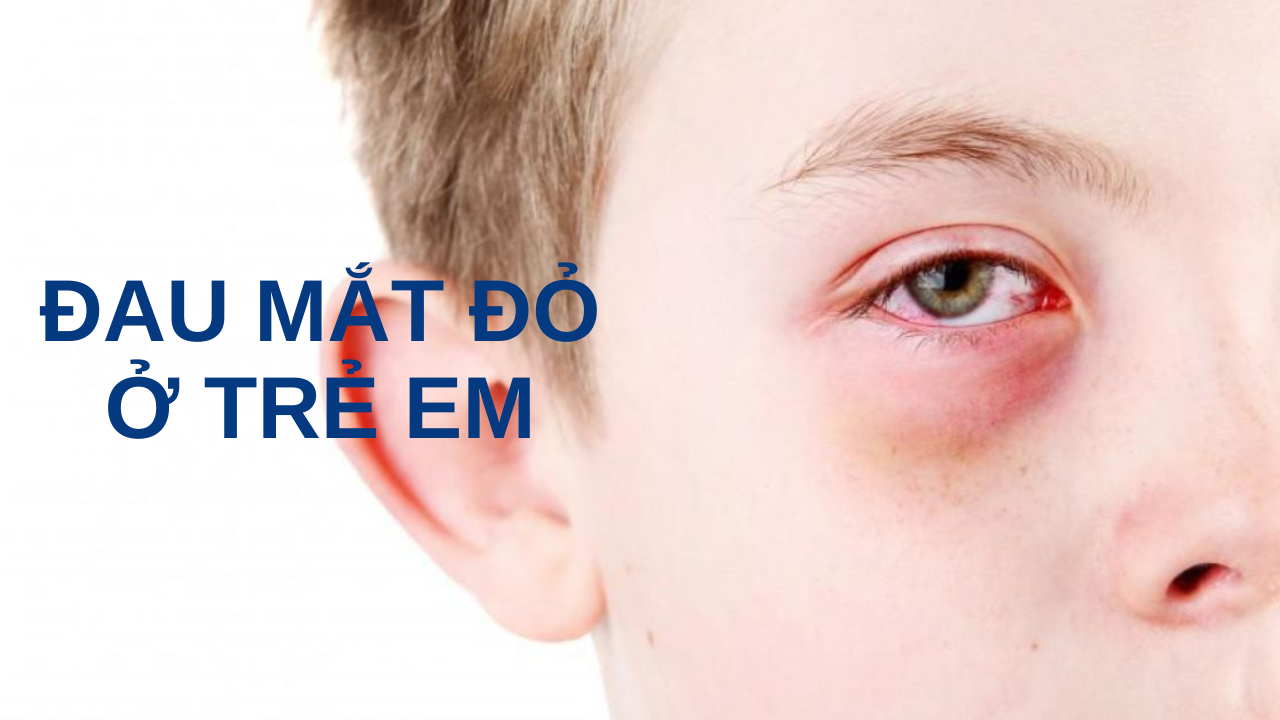 Dau mat do o tre em Đau mắt đỏ ở trẻ em: Nguyên nhân, triệu chứng và phòng ngừa Go1care