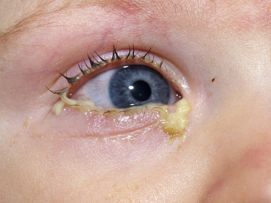 Triệu chứng đau mắt đỏ ở trẻ em