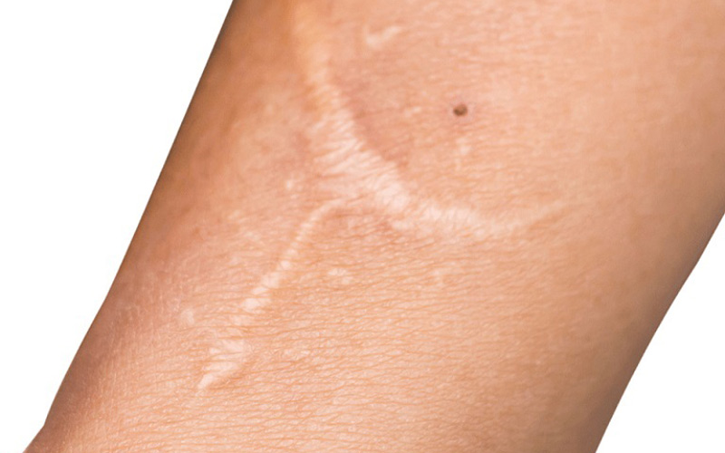 Bởi tác dụng của Collagen với da là có thể lấp đầy những vết lõm tương đối nông trên da