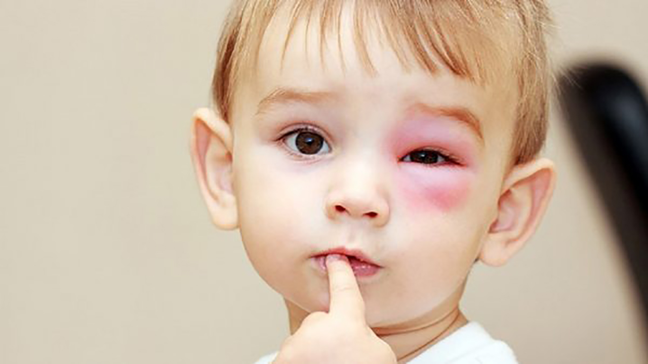 Triệu chứng và cách điều trị viêm kết mạc ở trẻ em go1care