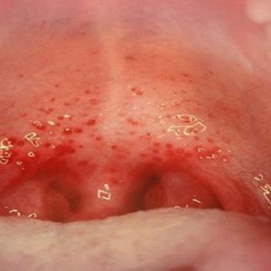 Bác sĩ CKI Đinh Thị Huyền Trang viem hong lien cau 1 Bác sĩ CKI Đinh Thị Huyền Trang Go1care