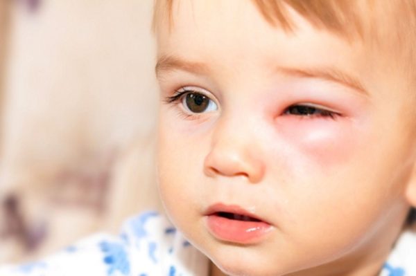 Viêm kết mạc ở trẻ em gây ngứa mắt, gây khó chịu cho trẻ go1care